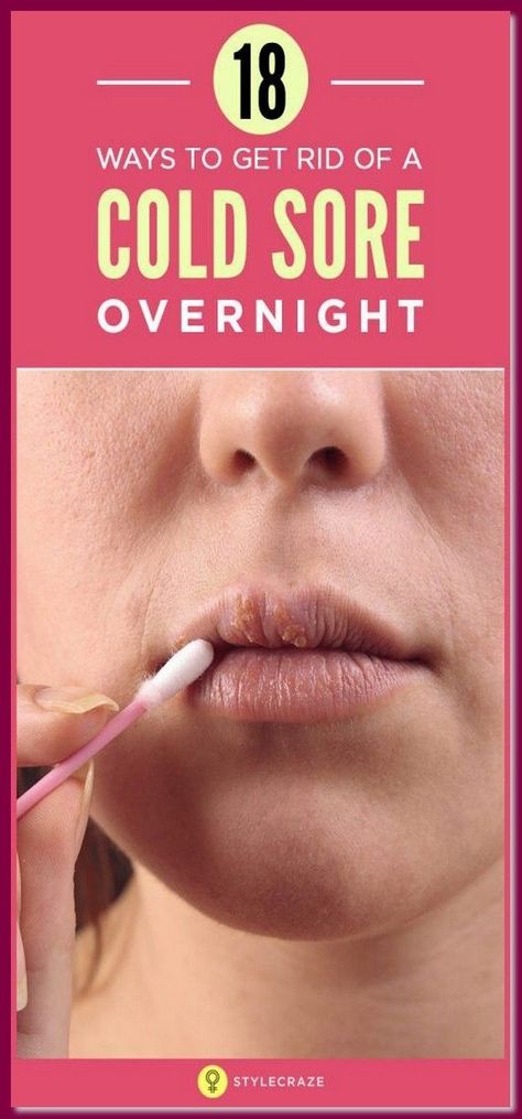 How To Get Rid Of A Cold Sore Overnight Without Medicine Cold Sore Remedy Fast, Cold Sore Remedy Overnight, Get Rid Of Cold, Fever Blister, Cold Sores, Canker Sore, Cold Sores Remedies, Spots On Face, Cold Sore