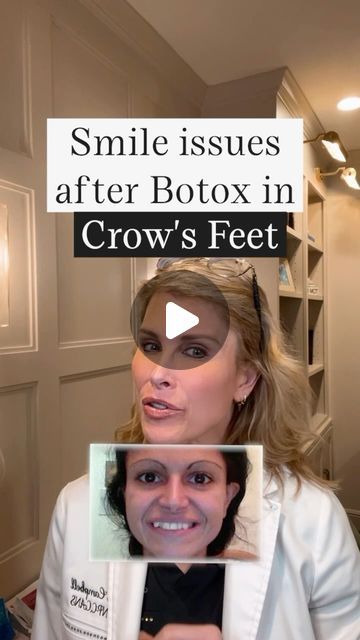 Botox For Crows Feet Before And After, Crows Feet Botox Before After, Crows Feet Botox Before After Eyes, Best Botox Injection Sites, Botox Crows Feet Eye, Botox Video Injections, Botox Under Eyes, Botox To Lift Corners Of Mouth, Botox Wrinkles