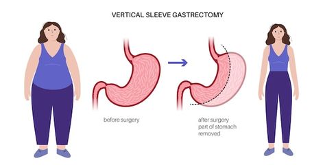 Vertical sleeve gastrectomy laparoscopy ... | Premium Vector #Freepik #vector #gastric-sleeve #gut #bariatric-surgery #digestion Vertical Sleeve Gastrectomy, Sleeve Gastrectomy, Sleeve Surgery, Premium Vector, Surgery, Quick Saves