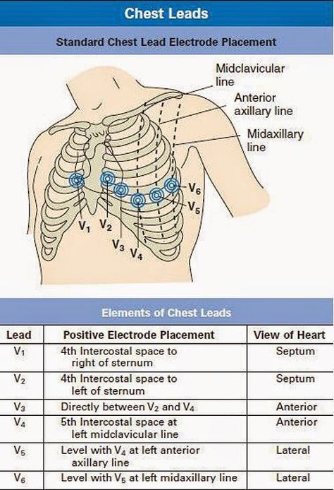 Standard chest lead electrode placement Ecg Reading, Ekg Interpretation, Heart Things, Paramedic School, Cardiac Nursing, Nursing School Survival, Critical Care Nursing, Nursing School Studying, Med Surg