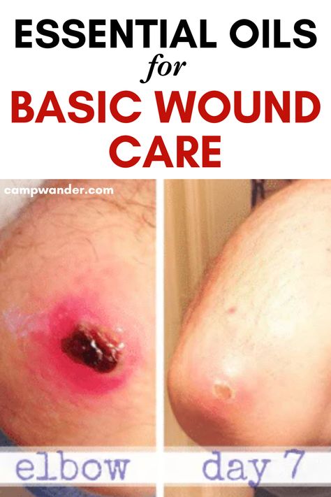 a healing wound before and after with text overlay essential oils for basic wound care Essential Oils To Heal Skin Wounds, Essential Oil For Open Wound, Wound Healing Remedies, Essential Oils For Wound Healing, Scab Healing, Antifungal Essential Oil, Heal Wounds Faster, Antibacterial Essential Oils, Essential Oils Dogs