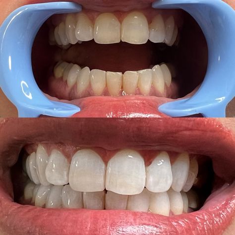 LED Teeth Whitening, Langley BC Langley Bc, Teeth Bleaching, Teeth Whitening, Do More, Bleach, Make Your, Led