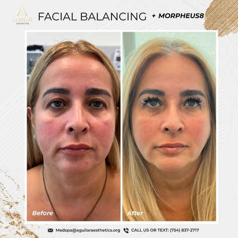 ✨ Facial Balance & Harmonization with Morpheus8 Technology ✨ Achieve rejuvenated skin and a balanced look with our combination of facial harmonization techniques and advanced Morpheus8 technology! Through a personalized approach, we redefine and sculpt facial contours, soften fine lines, improve skin texture, and create a refreshed, natural appearance. 💫 ✨ Aguilar Aesthetics & MedSpa 📲754-837-2717 💠www.aguilaraesthetics.com 🏢 ✨ Aguilar Aesthetics & MedSpa 📍 2820 NE 214th Street, Suite 844... Improve Skin Texture, Med Spa, Skin Texture, Improve Skin, Facial, Technology, Texture, Skin, Quick Saves