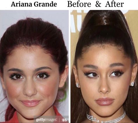 Nose - Lips - (weight loss - hair pulled tightly up duplicates face lift, but causes hair loss) Ponytail Lift Before And After, Ponytail Lift, Celebrity Surgery, Plastic Surgery Gone Wrong, Thread Lift, Loss Hair, Celebrity Plastic Surgery, Hair Pulling, The Kardashians