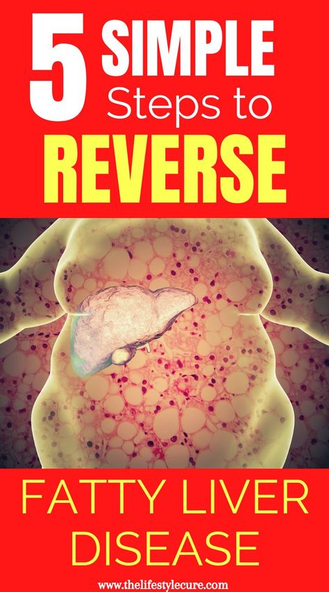 Want to reverse fatty liver disease? Well it's possible! As a medical doctor, chronic diseases make up the majority of cases that doctors see on a regular basis. But what most don't know is that these diseases are lifestyle related, meaning you can change the outcome! Read to know the 6 proven lifestyle changes that will reverse fatty liver disease and other chronic diseases. #reversefattyliverdisease #fattyliverdisease #fattyliver #howtogetridoffattyliver #fattyliverdiet Liver Diet Plan, Liver Healthy Foods, Liver Cleansing Foods, Liver Cleanser, Healthy Liver Diet, Liver Detox Diet, Heal Liver, Liver Care, Liver Issues