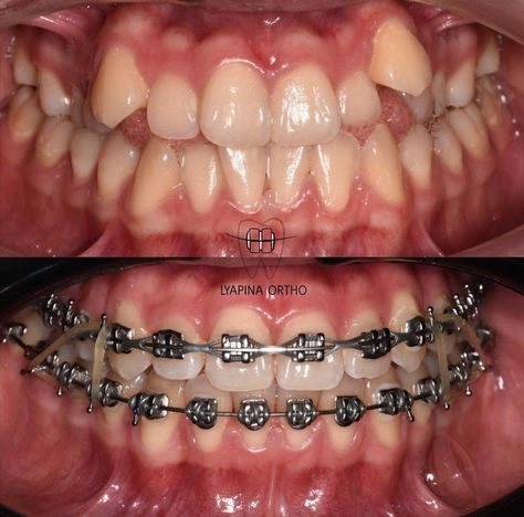 Teeth Braces Before And After, Teeth After Braces, Before And After Braces, Braces Before And After, Dental Animation, After Braces, Dental Wallpaper, Dream Face, Dental Photos