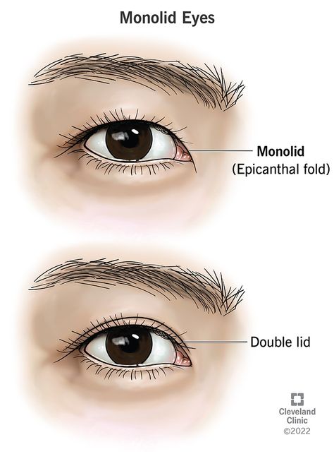 Monolid Eyes: Epicanthal Folds & Causes Epicanthic Fold, How To Draw Eyes, Monolid Eyes, How To Use Makeup, Droopy Eyelids, Fetal Alcohol, Draw Eyes, Excess Skin, Upper Eyelid