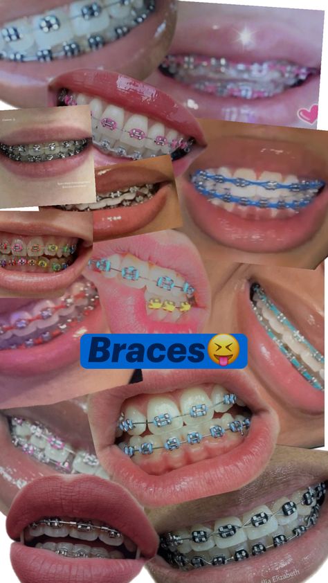 I love them but food gets stuck in them so bad!! Damon Braces, Gold Braces, Half Sleeve Tattoo Stencils, Cute Braces Colors, Funny School Videos, Pretty Teeth, Braces Tips, Getting Braces, Makeup Collection Goals