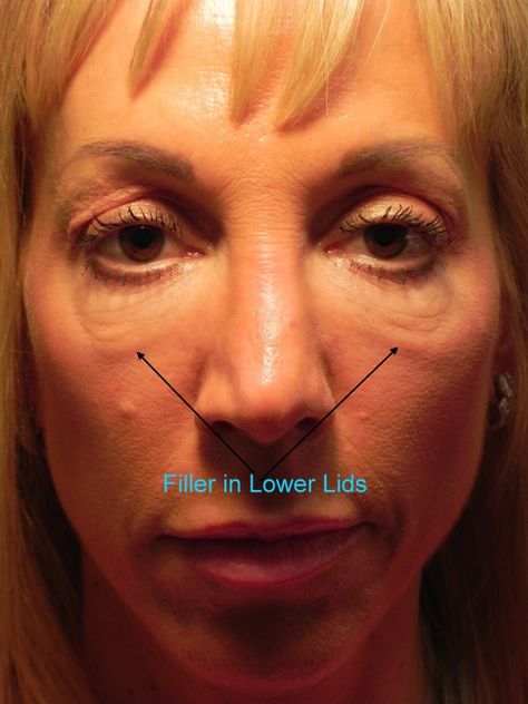 Under Eye Filler, Under Eye Hollows, Reduce Eye Bags, Under Eye Fillers, Medical Tips, Sunken Eyes, Laser Skin Resurfacing, Hyaluronic Acid Fillers, Newborn Feeding