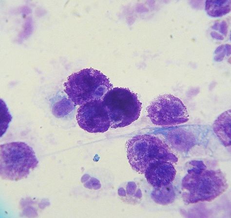 Cytology of a mast cell tumor from a Labrador Retriever. The magnification is 1000x. The cells are mast cells (although there are two granulocytes at the bottom and possibly a fibroblast to the right). The purple granules that are present in the cells are granules that contain histamine. Slide was stained with a modified Wright's stain. Clinical Pathology, Basement Membrane, Meds For Dogs, Vet Life, Cats And Cucumbers, Allergic To Cats, Mast Cell, Under The Microscope, Electron Microscope