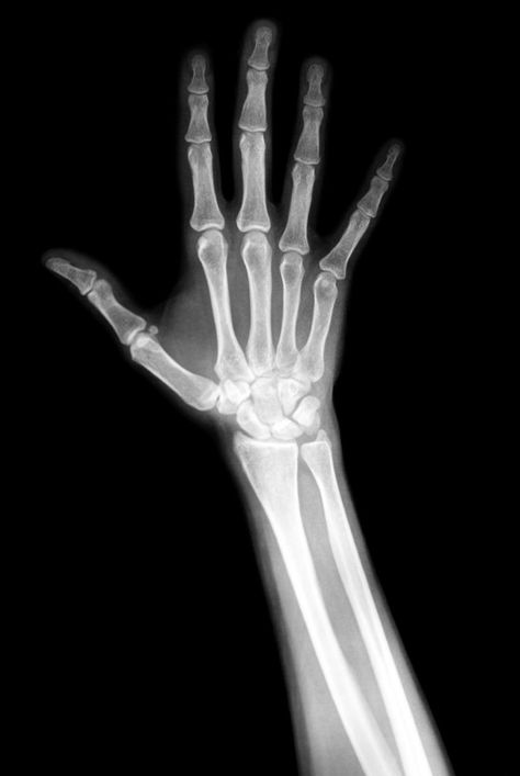 hand xray Theme Tattoo, Human Anatomy Art, Hand Reference, Stomach Pain, Radiology, Anatomy Art, Human Anatomy, X Ray, Wallpaper Backgrounds