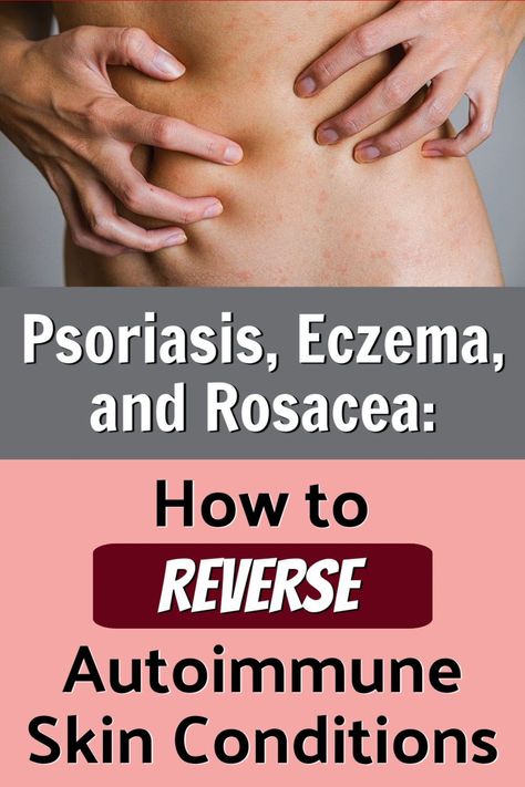 Do you have psoriasis, eczema, or rosacea? You might be able to improve your skin health significantly by eating a highly strategic, anti-inflammatory diet. Here's what you need to know. #psoriasis #eczema #rosacea #skin #health #antiinflammatory #diet #over50 Psoriatic Skin Remedies Diy, Psoriatic Diet, Psoriatic Skin Diet, Psoriatic Skin Remedies, Psoriatic Skin, Peroxide For Acne, Bath Therapy, Scalp Itch, Skin Diet