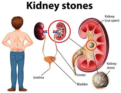 Heart Hospital, Creatinine Levels, Kidney Stone, Healthy Kidneys, Kidney Health, Homeopathy, Medical Conditions, Surgery, Health Tips