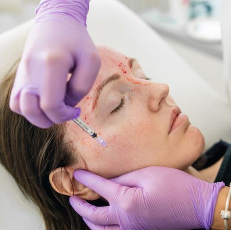 Vampire Facials Have Been Linked To 2 Cases Of HIV At A Spa In New Mexico Vampire Facial, Skin Needling, Platelet Rich Plasma, Facial Aesthetics, Aesthetic Medicine, Facial Rejuvenation, Aesthetic Clinic, Cosmetic Procedures, Collagen Production