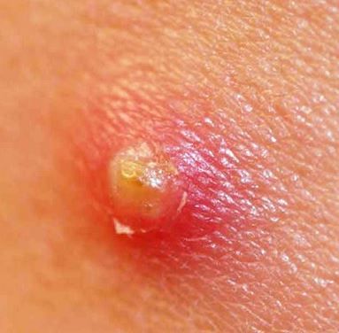 Explore more on how to treat a boil, best home remedies and natural ways on how to get rid of boils fast. Lancing A Boil, Natural Remedies For Boils, Get Rid Of Boils, Skin Boil, Warm Compress, Holistic Remedies, Homemade Remedies, Skin Diseases, Homeopathy