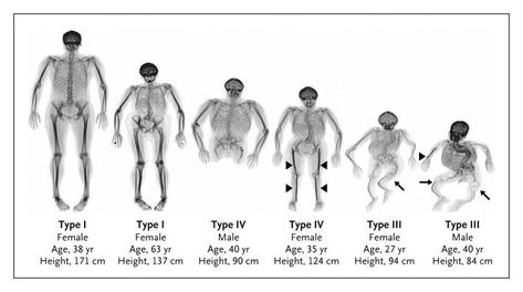 Osteogenesis Imperfecta, Triple Helix, Bone Diseases, Nurse Stuff, University College London, X Rays, Connective Tissue, Genetic Disorders, Forensic Science