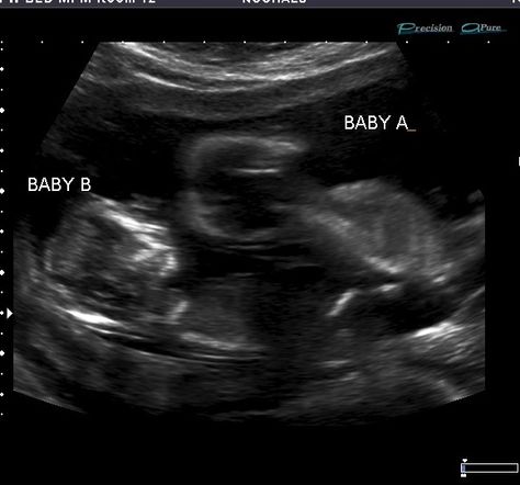 My Babies Usg Pregnancy Photography, Usg Pregnancy, Twins Ultrasound, Baby Ultrasound Pictures, 2 Months Pregnant, 12 Weeks Pregnant, Cute Relationship Pictures, 4d Ultrasound, Baby Ultrasound