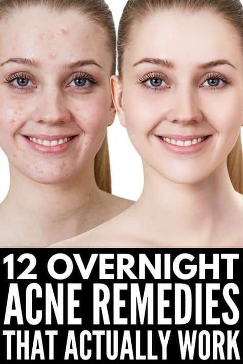 How to Get Rid of Acne Overnight: 12 Remedies that Work Rid Of Acne Overnight, Get Rid Of Acne Overnight, Your Twenties, Acne Overnight, Get Rid Of Acne, Rid Of Acne, How To Get Rid Of Acne, Homemade Remedies, Acne Prone Skin