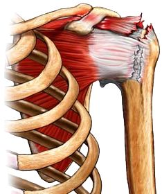 Torn Rotator Cuff Symptoms, Rotator Cuff Rehab, Shoulder Muscle Pain, Rotator Cuff Pain, Shoulder Anatomy, Rotator Cuff Surgery, Rotator Cuff Exercises, K Tape, Shoulder Dislocation