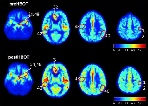 Study suggests Alzheimer's 'could be stopped' with oxygen therapy Hyperbaric Oxygen Therapy, Oxygen Therapy, Brain Tissue, Study Break, Nerve Cell, Medical Research, Brain Development, God's Grace, Alzheimers