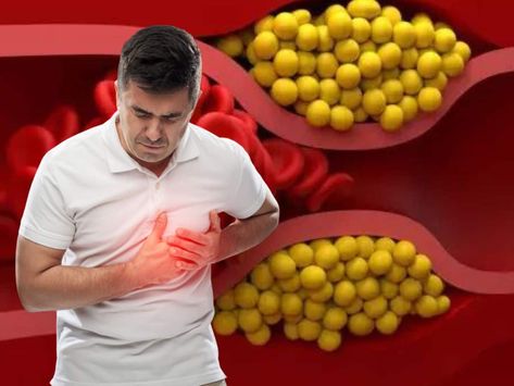 High Cholesterol Symptoms, Ways To Lower Cholesterol, Lower Cholesterol Naturally, Cholesterol Symptoms, Pilates Benefits, Plant Sterols, Cholesterol Lowering, Healthy Pregnancy Tips, Bad Cholesterol