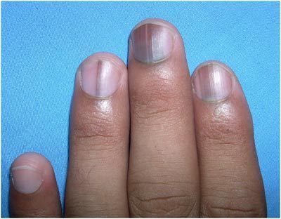 What Are The Effects Of Nutrient Deficiencies On Nails And How To Rectify Them? Vitamin deficiency nails Nail Symptoms, Nail Discoloration, Nail Conditions, Emerald Nails, Nail Problems, Nail Vitamins, Vitamin Deficiency, Fungal Nail, Nutrient Deficiency