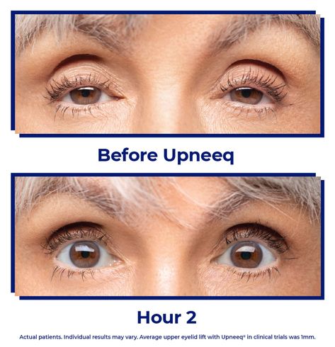 This New Eye Drop Lifts Droopy Eyelids Without Surgery - NewBeauty Eye Lid Lift Droopy Eyelids, Asymmetrical Eyes, Eye Lift Surgery, Drooping Eyelids, Eye Makeup Application, Droopy Eyelids, Droopy Eyes, Eyelid Lift, Eye Drop