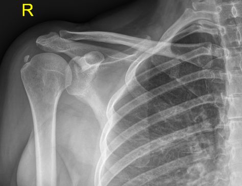 Calcific tendinitis is a self limiting condition due to deposition of calcium hydroxyapatite within tendons, usually of the rotator cuff.  Calcific deposits are usually visualised as homogeneous hyperdensity with variable morphology, but typically globular / amorphous with poor margins.  http://radiopaedia.org/articles/calcific-tendinitis Early 00s Aesthetic, Shoulder Anatomy, Shoulder Dislocation, Shoulder Impingement, Xray Technician, Bone Diseases, Geometric Symbols, Rotator Cuff, Love Quotes Wallpaper