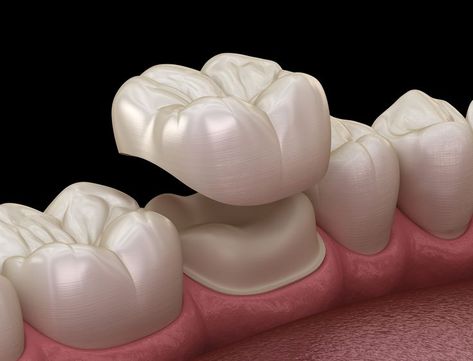 Are you looking for Dental Crowns Near Me? A pretty smile is the key to making a good impression. Fractured, damaged or decayed teeth bring sense of discomfort when smiling. Get a Porcelain Dental Crown Today! Porcelain Crowns, Cracked Tooth, Tooth Crown, Dental Images, Loose Tooth, Dental Bridge, Dental Art, Dental Crowns, Natural Teeth Whitening