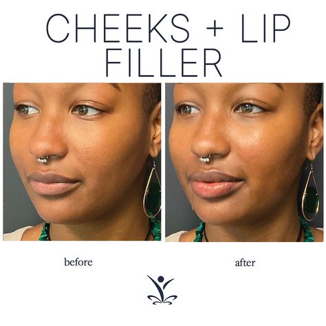 Lip Lift Before And After, Cheek Fillers Before And After Face, Lips Inspiration, Face Fillers, Cheek Fillers, Fountain Of Youth, Lip Fillers, Hair Growth, Eyelashes