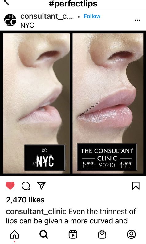 Very Natural Lip Filler, Lip Filler Downturned Lips, Lip Filler Smile Before And After, Angelic Lip Filler, Flat Lips Filler, Natural Lip Fillers 0.5ml, 0.5ml Lip Filler Before And After, Lip Flip Botox Before And After, Lip Filler Inspiration