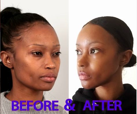 Click to read her story. She had Forehead reduction, Rhinoplasty, V-line surgery, Cheekbone reduction and Fat graft in ID Hospital.  #idhospital #cheekbonereduction #fatgraft #mommymakeover #vline #vlinesurgery #rhinoplasty #plasticsurgerinkorea #plasticsurgerybeforeafter #koreanplasticsurgery #antiaging #transformation #transformationpicture Face Contouring Surgery, Fat Grafting Face, Reduction Rhinoplasty, Perfect Forehead, Cheekbone Reduction, Forehead Reduction, Look More Feminine, V Line Surgery, Ethnic Rhinoplasty