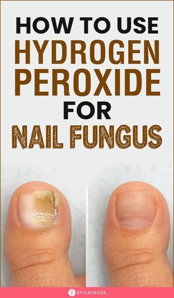 Symptoms of nail fungus vary in severity and may include: Nail discoloration (white, yellow, or brown). Nail thickening. Nail cracking. Nail fragility. Nail distortion. Nail pain (in severe cases). Slight foul odor. Fungal skin infection of the foot, commonly between the toes (may accompany a fungal toenail infection). While fungal nail infections can infect fingernails and toenails, toenails are more commonly affected. |Feet nails |feet pictures |feet pics |feet care Penny Ball, Toenail Health, Nail Remedies, Toenail Fungus Remedies, Nail Fungus Remedy, Nail Infection, Holistic Diet, Fungal Nail, Home Health Remedies