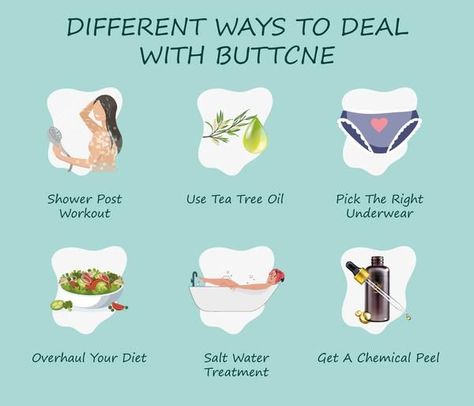 Acne can be treated on the buttock area, similarly to how you treat other areas of the body such as the face or trunk area. Tap the pin to know more! Buttocks Acne, Good Skin Tips, Treat Acne, Scarring, Chemical Peel, How To Treat Acne, Skin Tips, Tea Tree Oil, Tea Tree