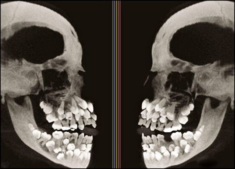 Hyperdontia x-rays Odd Facts, Dental Humor, Crazy Stuff, Dental Hygienist, Dental Assistant, Radiology, Health Advice, Spongebob Squarepants, Anthropology