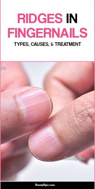 Fingernail Ridges, Fingernail Health, Natural Hair Removal Remedies, Nail Remedies, Nail Ridges, Nail Problems, Nail Fungus Remedy, Fungal Nail, Finger Nails