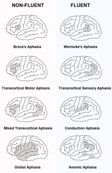 Learn about all the different types of aphasia and the areas that they affect the brain. Medical Speech Language Pathology, Slp Grad School Aesthetic, Medical Slp Aesthetic, Speech Therapy Aesthetic, Speech Pathology Aesthetic, Slp Praxis, Slp Grad School, Slp Aesthetic, Speech Language Pathology Grad School