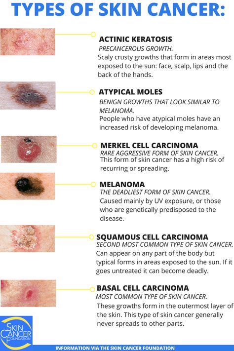 Dermatology Nurse, Wound Care Nursing, Basal Cell, Skin Moles, Squamous Cell, Nursing School Survival, Types Of Skin, Nursing School Tips, Medical School Studying