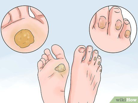 How to Treat a Corn or Callus (with Pictures) - wikiHow Callus Remover Diy, Cracked Feet Remedies, Christmas Gifts List, Get Rid Of Corns, Remedies For Cracked Heels, Corn Removal, Feet Remedies, Ny House, How To Make Corn