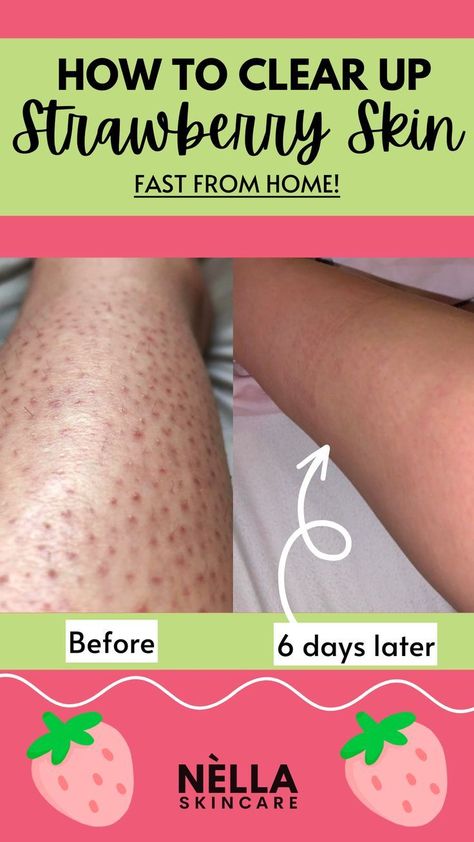 How I cleared up my Strawberry Legs Fast from Home Kp Skin, Kp Bump Eraser, Bump Eraser, Strawberry Skin, Natural Scrub, Dry Skincare, Strawberry Legs, Keratosis Pilaris, Smooth Legs