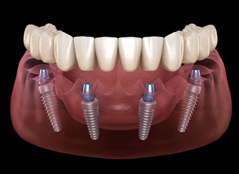 Dental Implant Procedure, Implant Dentist, Best Dental Implants, Dental Restoration, Dental Implant Surgery, Dental Implants Cost, Implant Dentistry, Teeth Implants, Dental Veneers