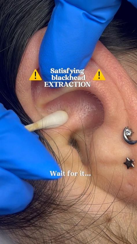 We can't believe this was in her EAR! 🤩 Black Head Removal Video Nose, Ear Pimple, Pimple Pop, Popping Pimples, Blackhead Extraction, Satisfying Stuff, Blackhead Mask, Face Care Routine, Hair Follicles