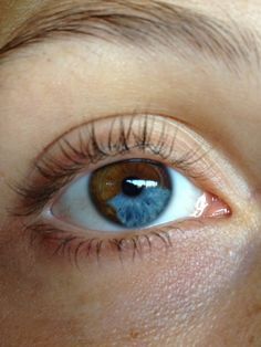 Segmental heterochromia in my left eye but not as pronounced as this Central Hetrochormia Eyes, Hetrochormia Eyes Boy, Sectoral Heterochromia, Pretty Eyes Color, Heterochromia Eyes, Rare Eyes, Head Anatomy, Beautiful Eyes Color, Eye Parts