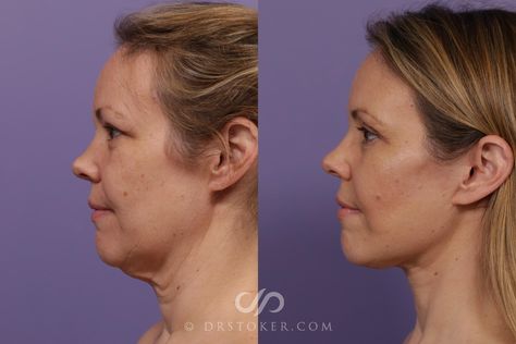 Facelift Recovery, Plastic Surgery Pictures, Facelift Before And After, Mommy Makeover, Redondo Beach, Breast Augmentation, Tummy Tucks, After Pictures, Before And After Pictures