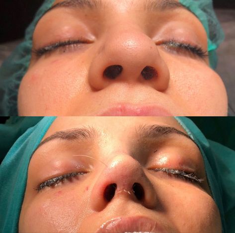 The Perfect Nose, Nose Plastic Surgery, Nose Surgery Rhinoplasty, Ethnic Rhinoplasty, Bulbous Nose, Plastic Surgery Fail, Rhinoplasty Nose Jobs, Face Surgery, Botox Lips