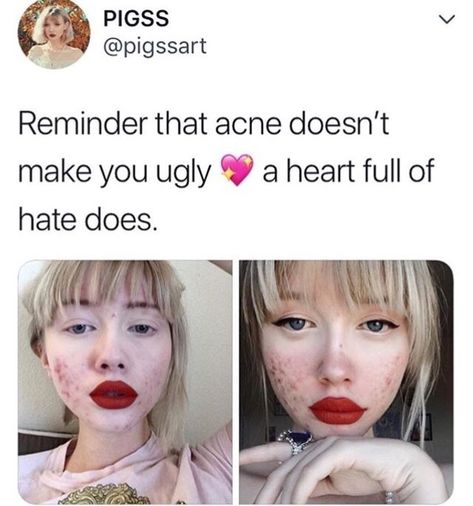 Girl With Acne, Pimple Patch, Hormonal Acne, Get Rid Of Blackheads, Cystic Acne, Free Girl, Beauty Standards, Acne Skin, Red Lipstick