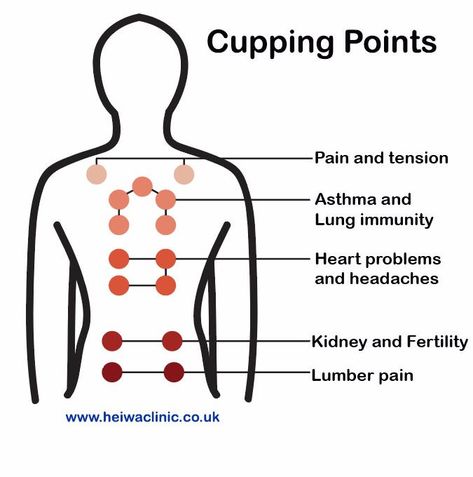 Cupping Therapy for better health