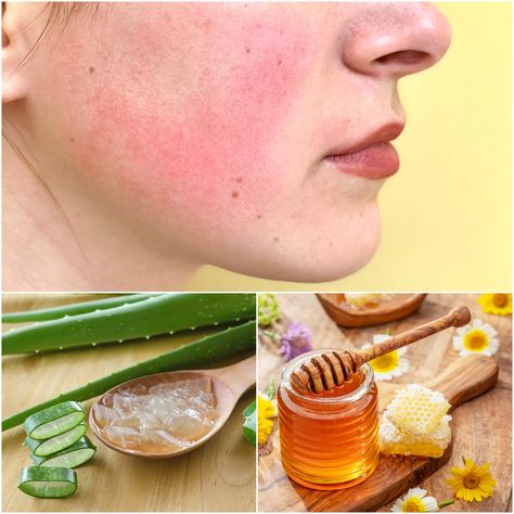 Home Remedies for Rosacea Soothing and Calming Skin Redness and Flare-ups Remove Redness From Face, Red Spots On Face, Redness Reducing Skin Care, Pregnancy Remedies, Face Cream Recipe, Skin Natural Remedies, Mild Cleanser, Skin Redness, Diy Hair Care