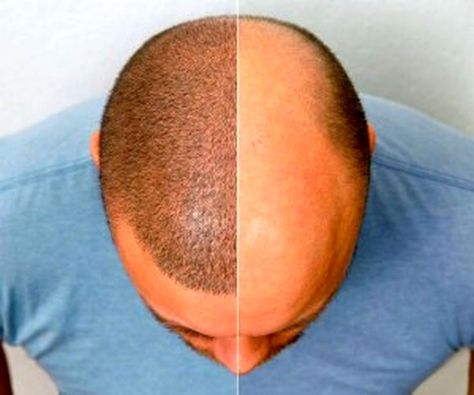 Alopecia Natural Remedies, Scarring Alopecia, Hair Implants, Hair Transplant Cost, Hair Transplant Results, Hair Transplant Procedure, Fue Hair Transplant, Hair Transplant Surgery, Best Hair Transplant