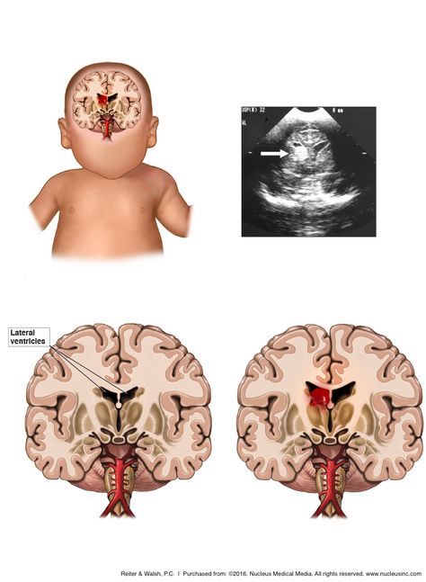 Intracranial hemorrhages (otherwise known as brain bleeds) are a type of traumatic birth injury that range from minor to extremely severe. It is important to diagnose intracranial hemorrhages as soon as possible in order to provide the right type of treatments and to limit the extent of the damage. Traumatic Birth, Intracranial Hemorrhage, Premature Birth, Ectopic Pregnancy, Medical Malpractice, Umbilical Cord, Pregnancy Symptoms, Medical Knowledge, Labor And Delivery